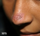 lupus erythematosus chronicus discoides