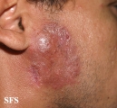 lupus erythematosus chronicus discoides