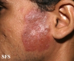lupus erythematosus chronicus discoides