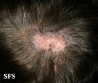 lupus erythematosus chronicus discoides