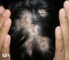 lupus erythematosus chronicus discoides