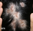 lupus erythematosus chronicus discoides