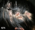 lupus erythematosus chronicus discoides