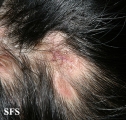 lupus erythematosus chronicus discoides