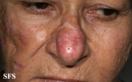 lupus erythematosus chronicus discoides