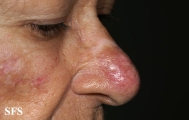 lupus erythematosus chronicus discoides