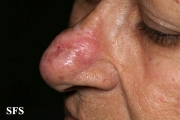 lupus erythematosus chronicus discoides