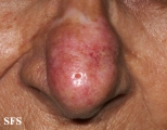 lupus erythematosus chronicus discoides