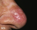 lupus erythematosus chronicus discoides