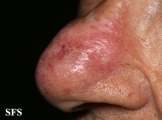 lupus erythematosus chronicus discoides