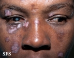 lupus erythematosus chronicus discoides