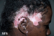 lupus erythematosus chronicus discoides