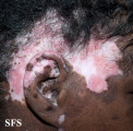 lupus erythematosus chronicus discoides