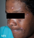 lupus erythematosus chronicus discoides