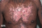 lupus erythematosus chronicus discoides
