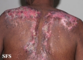 lupus erythematosus chronicus discoides