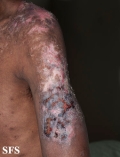 lupus erythematosus chronicus discoides