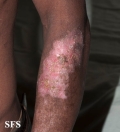 lupus erythematosus chronicus discoides