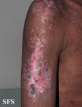 lupus erythematosus chronicus discoides