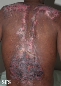 lupus erythematosus chronicus discoides