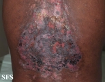lupus erythematosus chronicus discoides