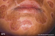 lupus erythematosus chronicus discoides