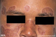 lupus erythematosus chronicus discoides