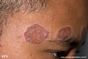 lupus erythematosus chronicus discoides