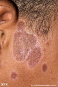 lupus erythematosus chronicus discoides