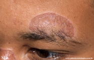 lupus erythematosus chronicus discoides