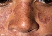 lupus erythematosus chronicus discoides
