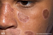 lupus erythematosus chronicus discoides