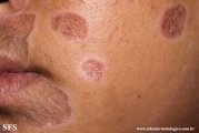 lupus erythematosus chronicus discoides