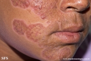 lupus erythematosus chronicus discoides