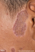lupus erythematosus chronicus discoides