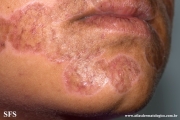 lupus erythematosus chronicus discoides