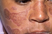 lupus erythematosus chronicus discoides