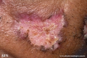 lupus erythematosus chronicus discoides