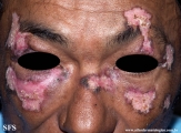 lupus erythematosus chronicus discoides