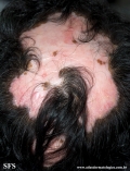 lupus erythematosus chronicus discoides