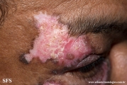 lupus erythematosus chronicus discoides