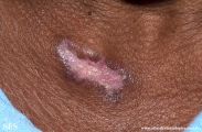 lupus erythematosus chronicus discoides