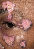 lupus erythematosus chronicus discoides