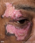 lupus erythematosus chronicus discoides
