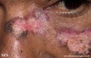 lupus erythematosus chronicus discoides