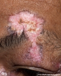 lupus erythematosus chronicus discoides