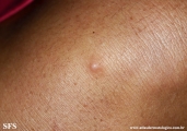 angioleiomyoma