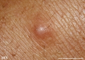 angioleiomyoma