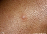 angioleiomyoma
