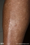 angioleiomyoma